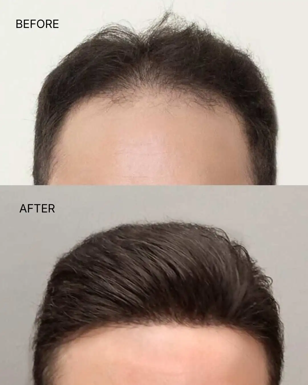Lace Front Hair Patch | Natural Looking Hairline - Image 2